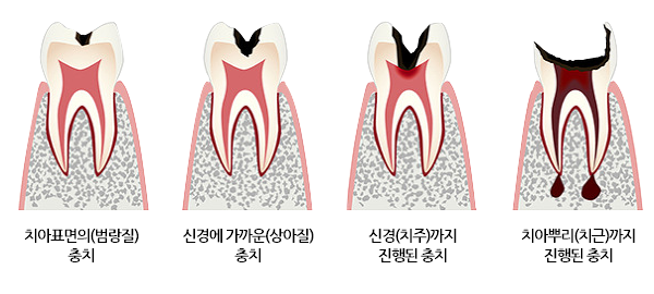 치아우식증(충치)의 진행 과정은?